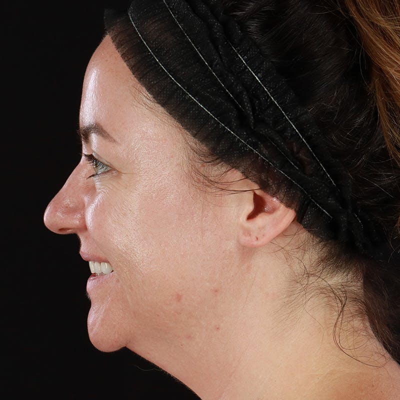 Botox Before & After Gallery - Patient 298673 - Image 10