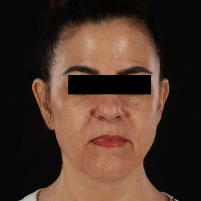 HALO™ Laser Treatment Before & After Gallery - Patient 167701 - Image 1