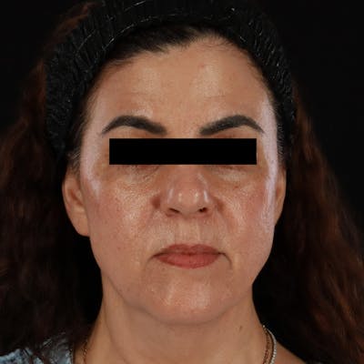 HALO™ Laser Treatment Before & After Gallery - Patient 167701 - Image 2