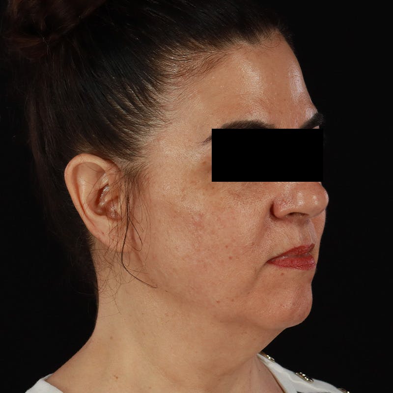 HALO™ Laser Treatment Before & After Gallery - Patient 167701 - Image 3