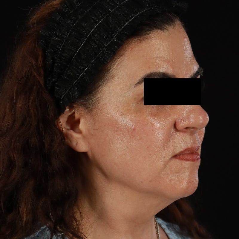 HALO™ Laser Treatment Before & After Gallery - Patient 167701 - Image 4