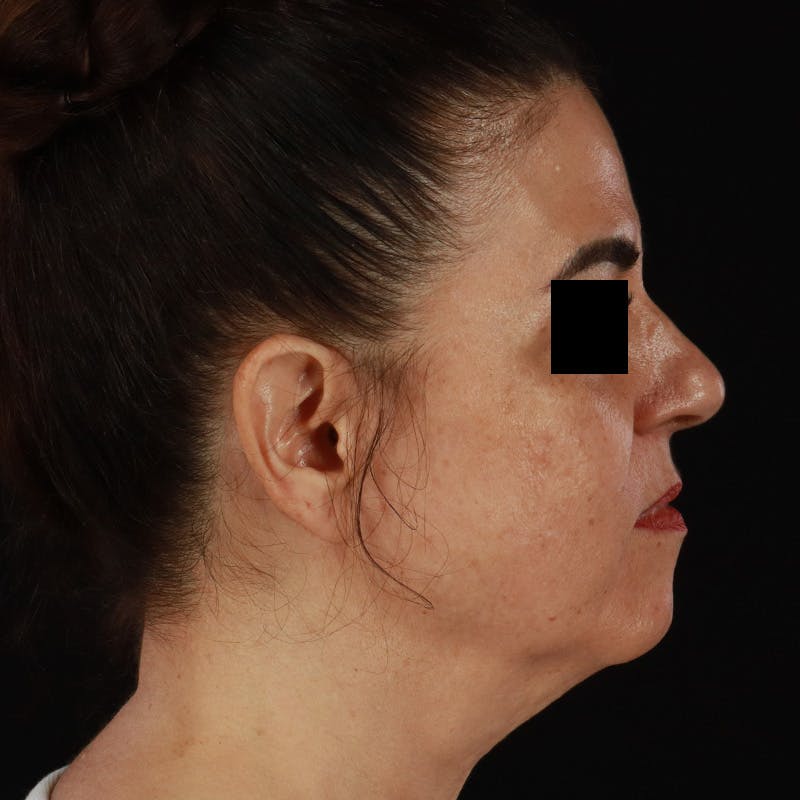 HALO™ Laser Treatment Before & After Gallery - Patient 167701 - Image 5