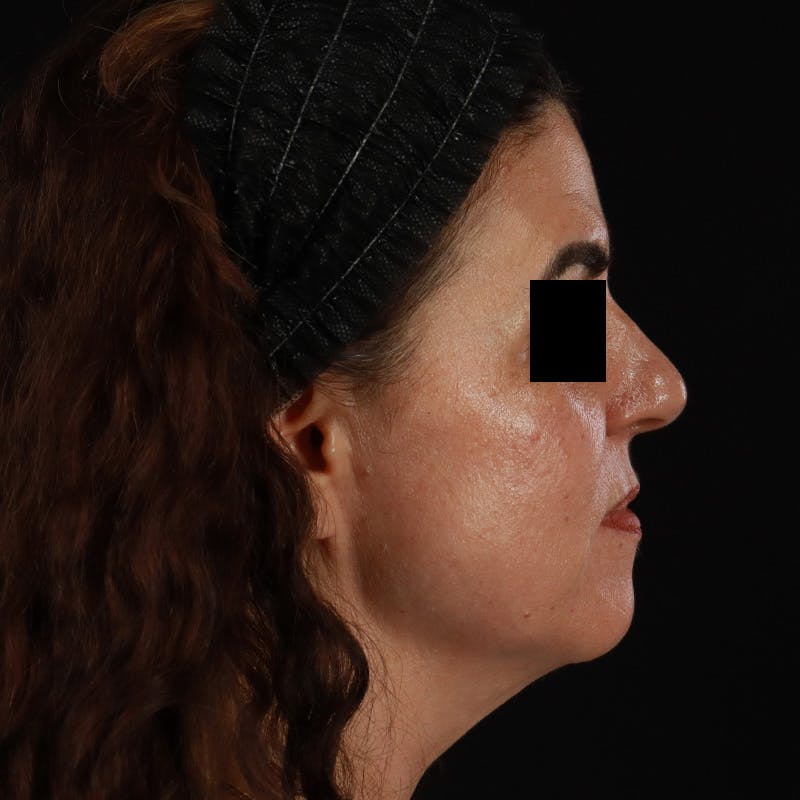 HALO™ Laser Treatment Before & After Gallery - Patient 167701 - Image 6