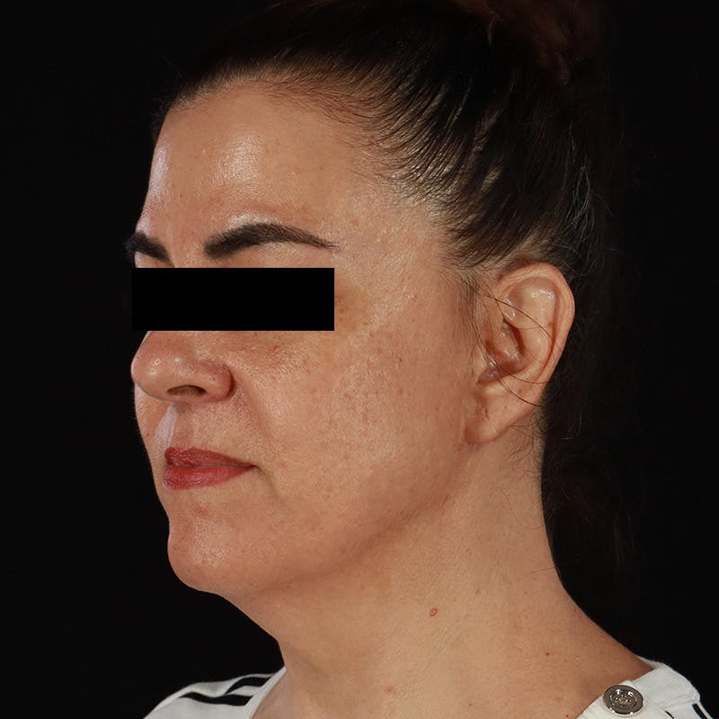 HALO™ Laser Treatment Before & After Gallery - Patient 167701 - Image 7