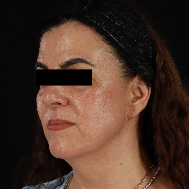 HALO™ Laser Treatment Before & After Gallery - Patient 167701 - Image 8