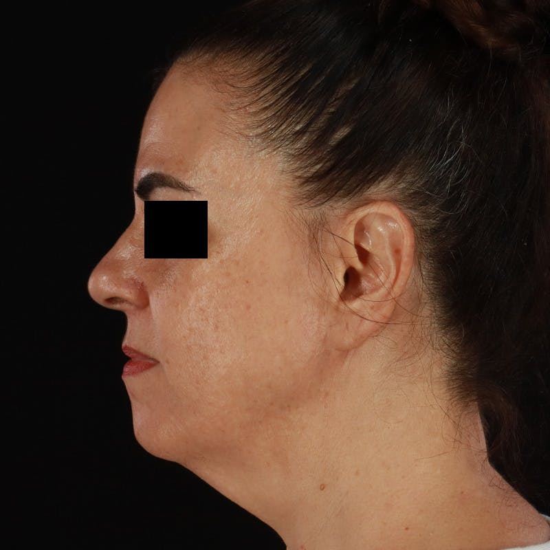 HALO™ Laser Treatment Before & After Gallery - Patient 167701 - Image 9