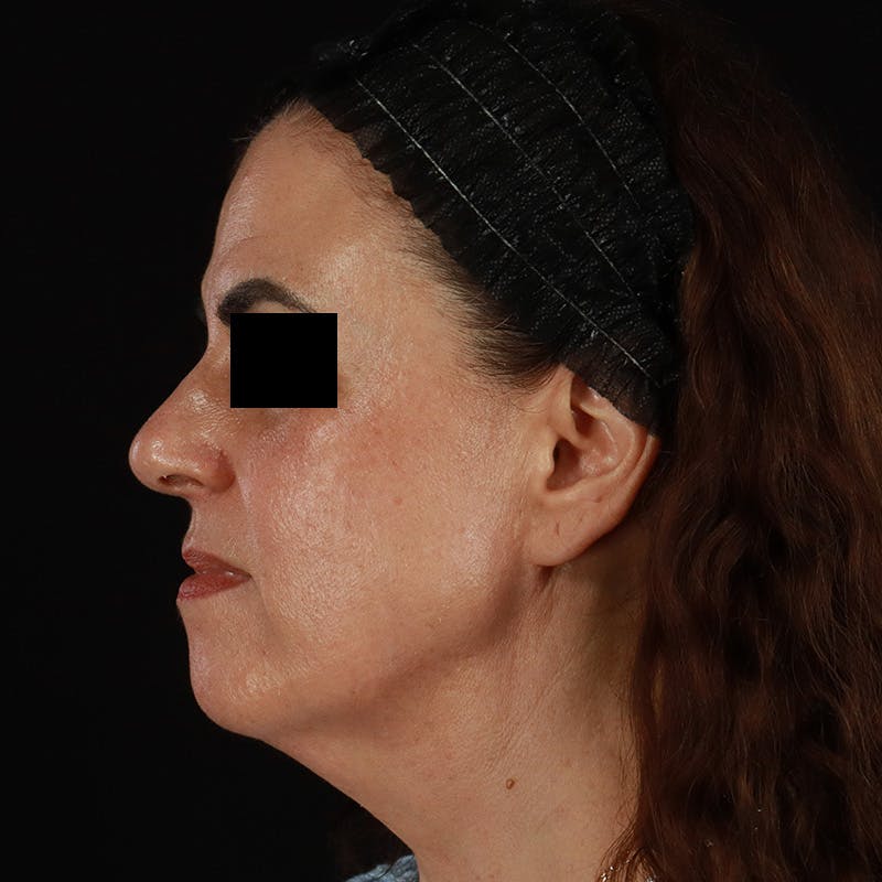 HALO™ Laser Treatment Before & After Gallery - Patient 167701 - Image 10
