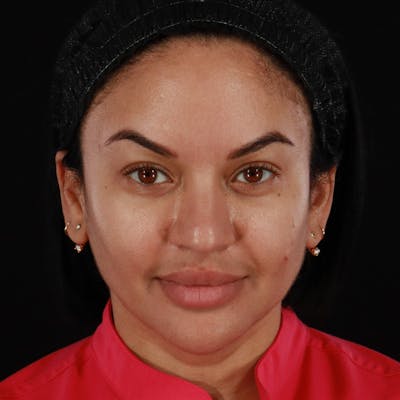 Dermal Fillers Before & After Gallery - Patient 399806 - Image 2