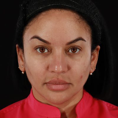 Dermal Fillers Before & After Gallery - Patient 399806 - Image 1