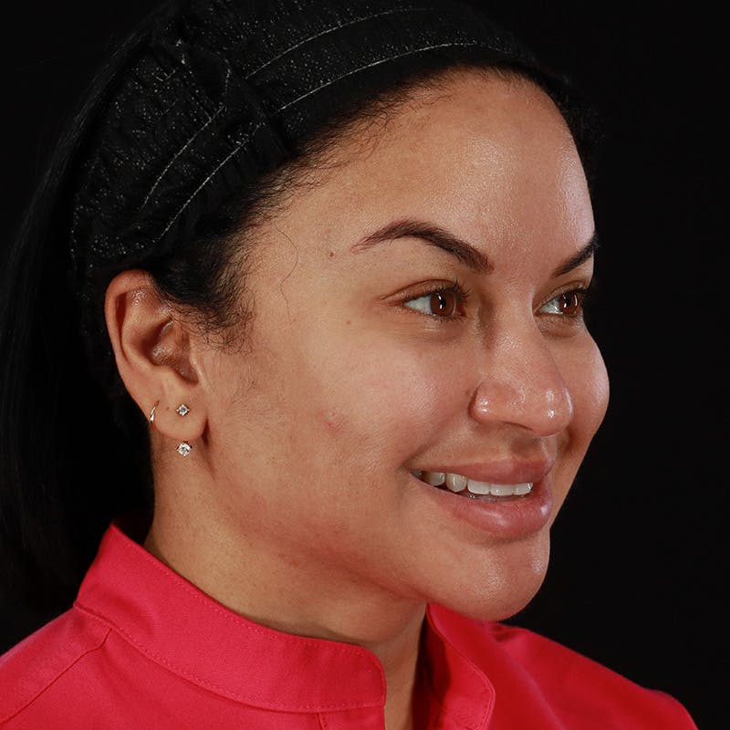 Dermal Fillers Before & After Gallery - Patient 399806 - Image 6