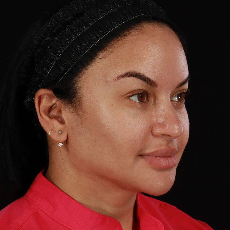 Dermal Fillers Before & After Gallery - Patient 399806 - Image 4