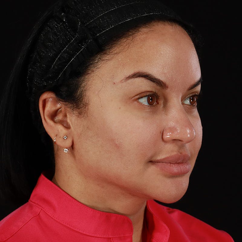 Dermal Fillers Before & After Gallery - Patient 399806 - Image 3
