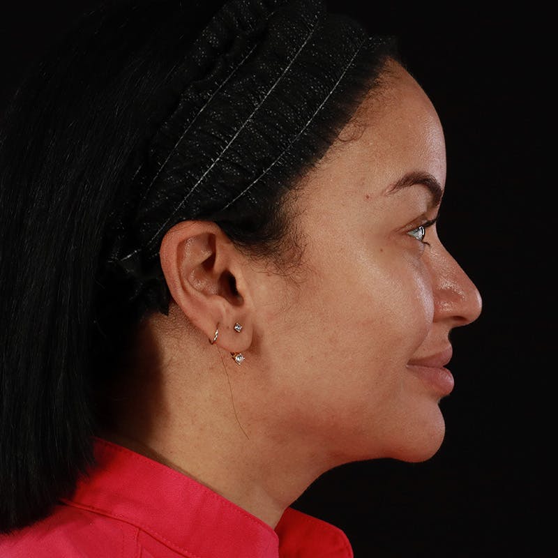 Dermal Fillers Before & After Gallery - Patient 399806 - Image 7