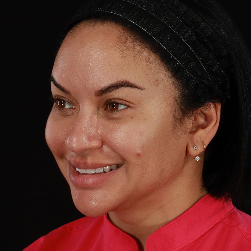 Dermal Fillers Before & After Gallery - Patient 399806 - Image 11