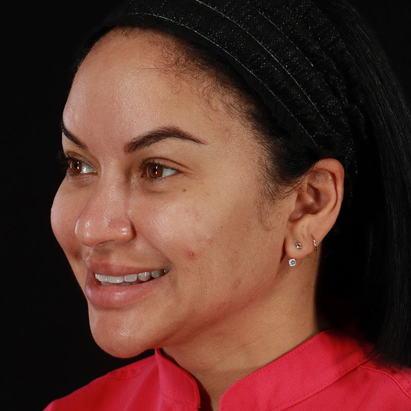 Dermal Fillers Before & After Gallery - Patient 399806 - Image 12