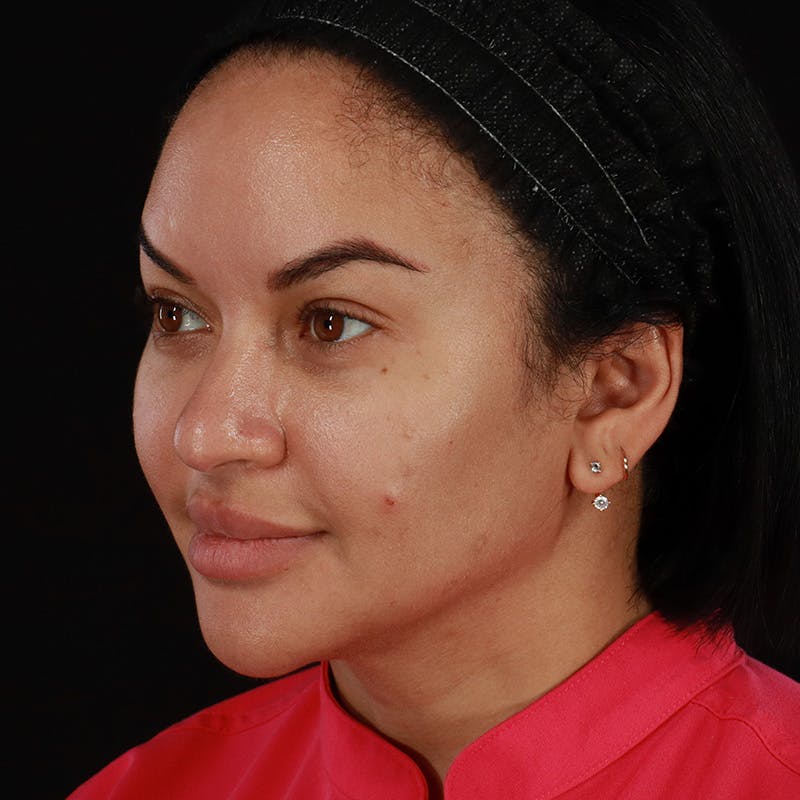 Dermal Fillers Before & After Gallery - Patient 399806 - Image 9