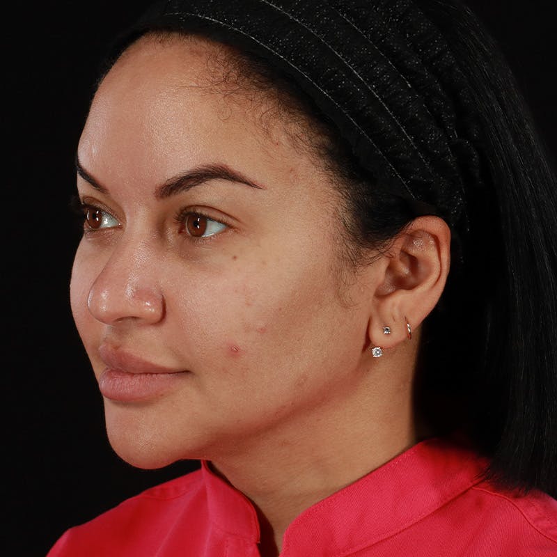 Dermal Fillers Before & After Gallery - Patient 399806 - Image 10