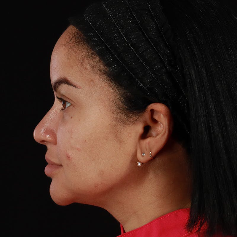 Dermal Fillers Before & After Gallery - Patient 399806 - Image 14