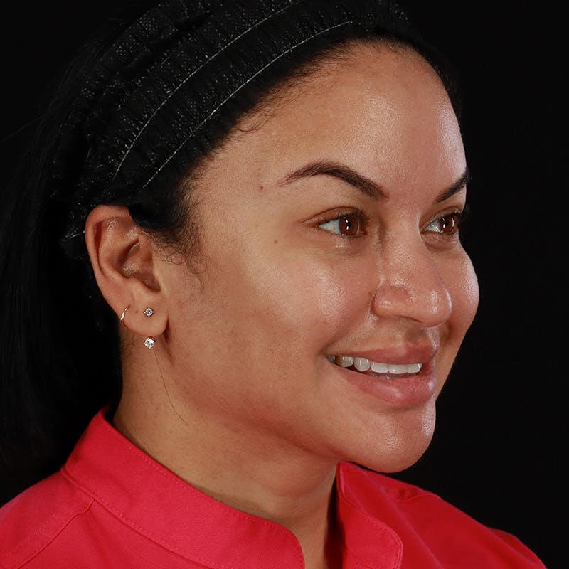 Dermal Fillers Before & After Gallery - Patient 399806 - Image 5
