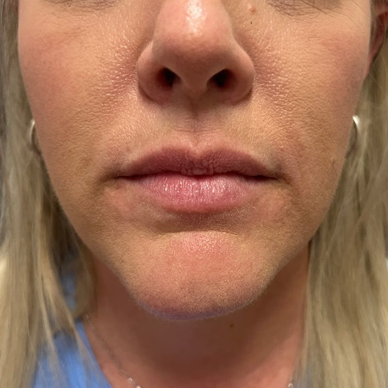 Dermal Fillers Before & After Gallery - Patient 196932 - Image 1