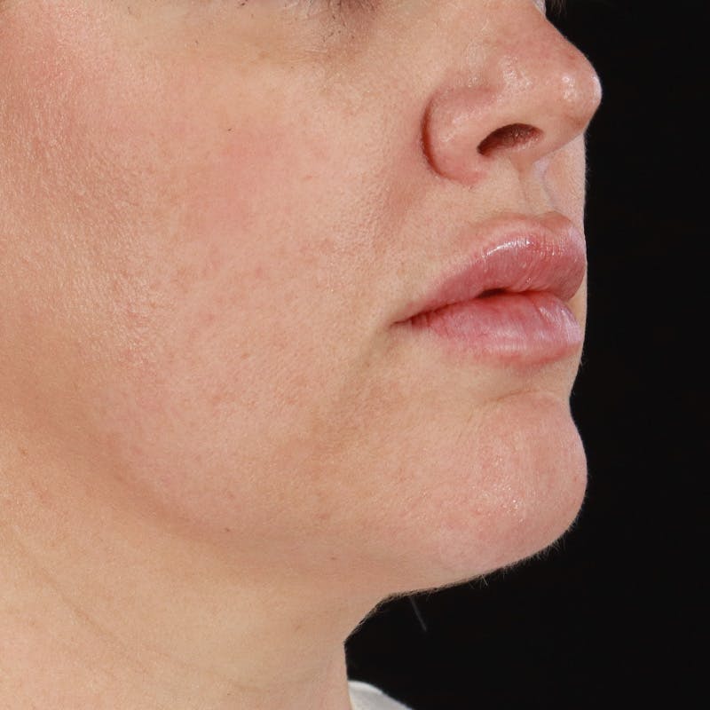 Dermal Fillers Before & After Gallery - Patient 196932 - Image 4