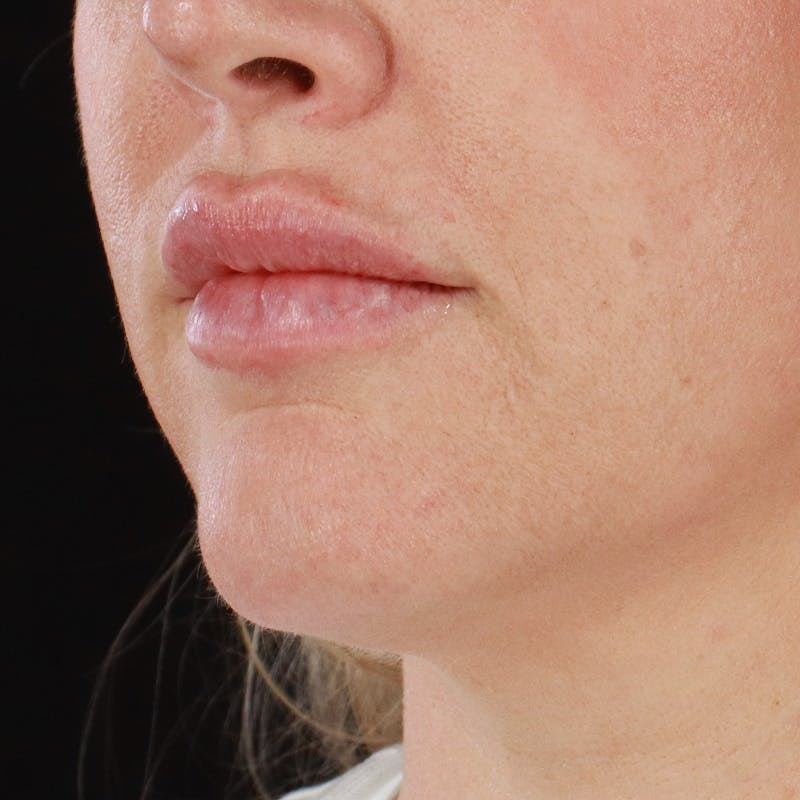 Dermal Fillers Before & After Gallery - Patient 196932 - Image 6