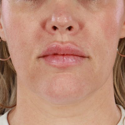 Dermal Fillers Before & After Gallery - Patient 196932 - Image 2
