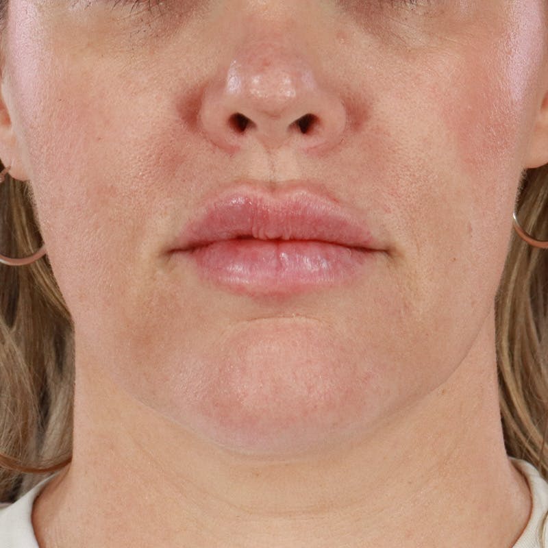 Dermal Fillers Before & After Gallery - Patient 196932 - Image 2