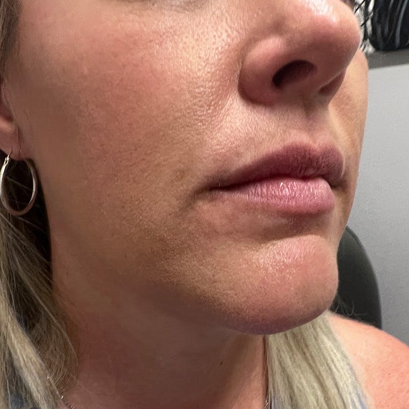 Dermal Fillers Before & After Gallery - Patient 196932 - Image 3