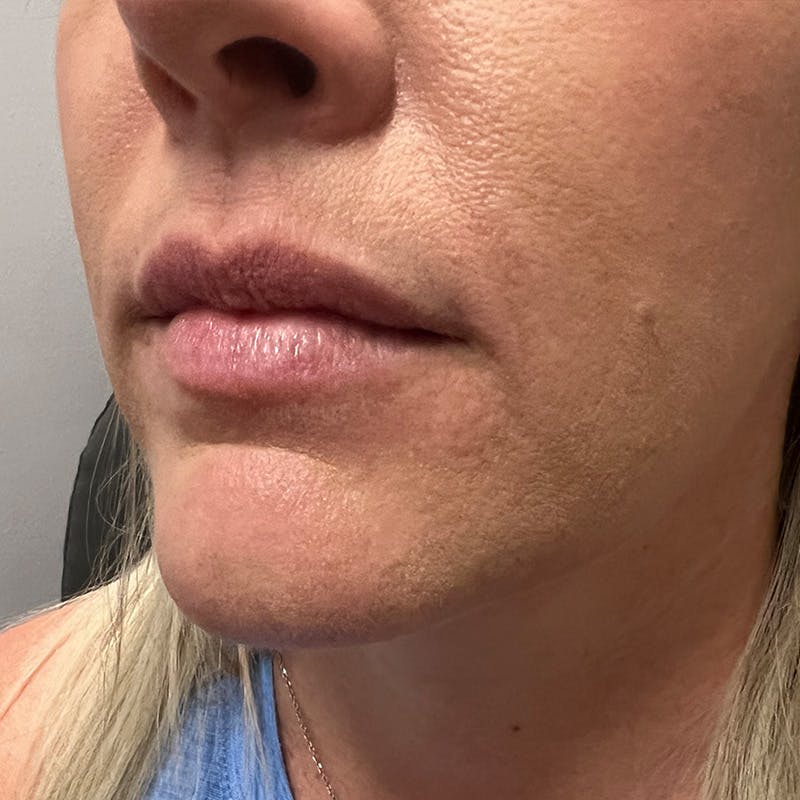 Dermal Fillers Before & After Gallery - Patient 196932 - Image 5