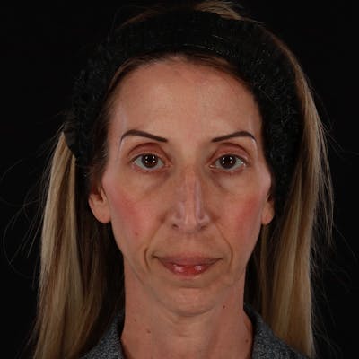 Dermal Fillers Before & After Gallery - Patient 121461 - Image 1