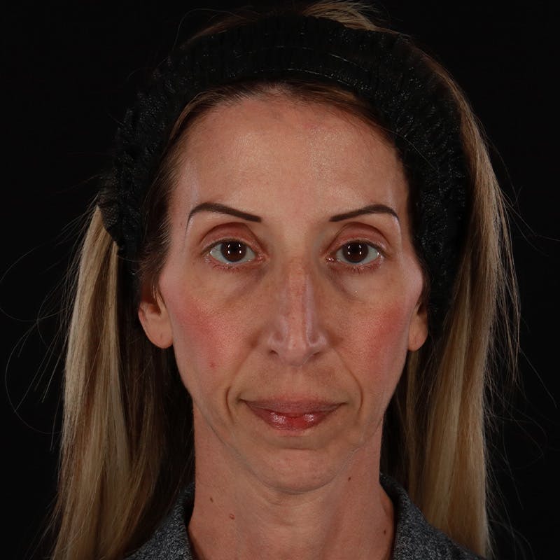 Dermal Fillers Before & After Gallery - Patient 121461 - Image 1