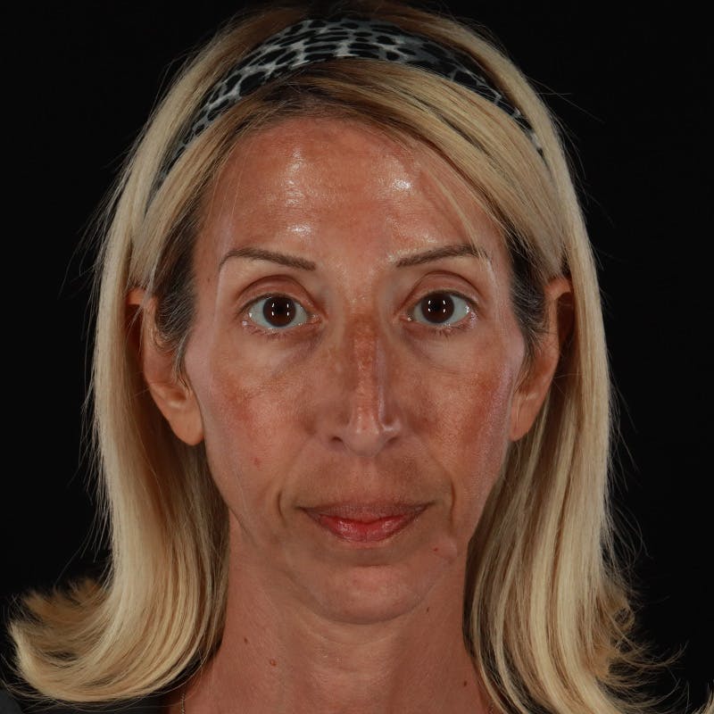 Dermal Fillers Before & After Gallery - Patient 121461 - Image 2