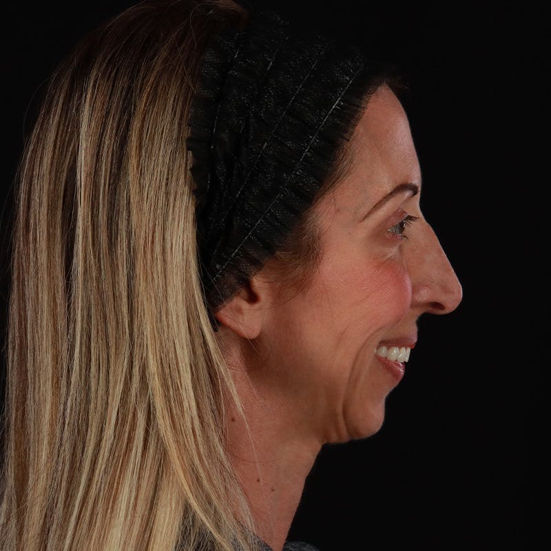 Dermal Fillers Before & After Gallery - Patient 121461 - Image 5