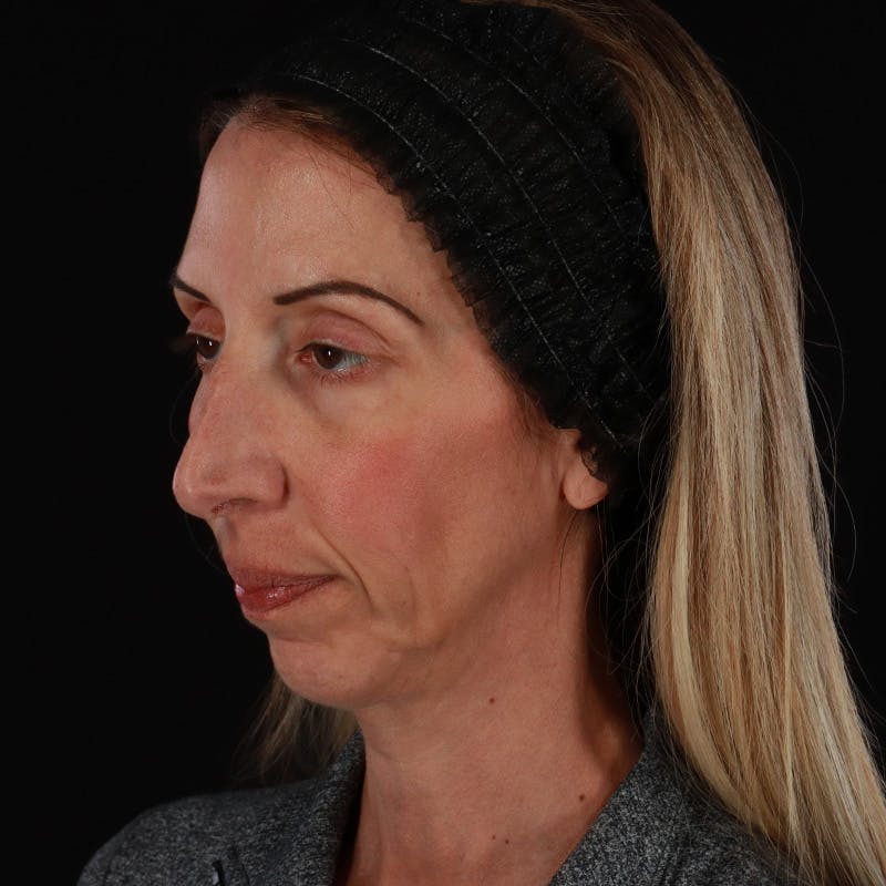 Dermal Fillers Before & After Gallery - Patient 121461 - Image 3