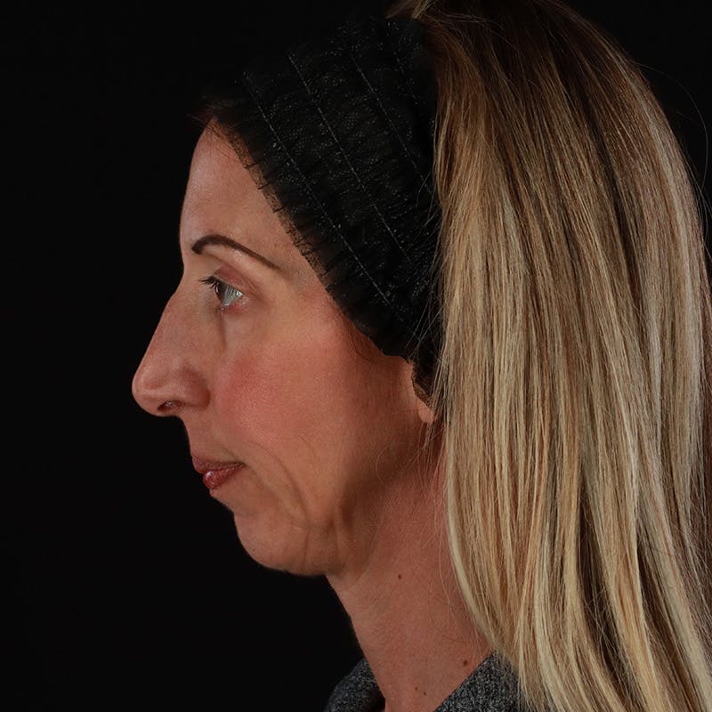 Dermal Fillers Before & After Gallery - Patient 121461 - Image 7