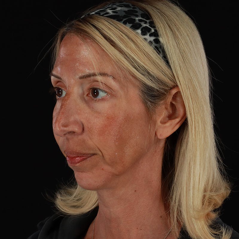 Dermal Fillers Before & After Gallery - Patient 121461 - Image 4