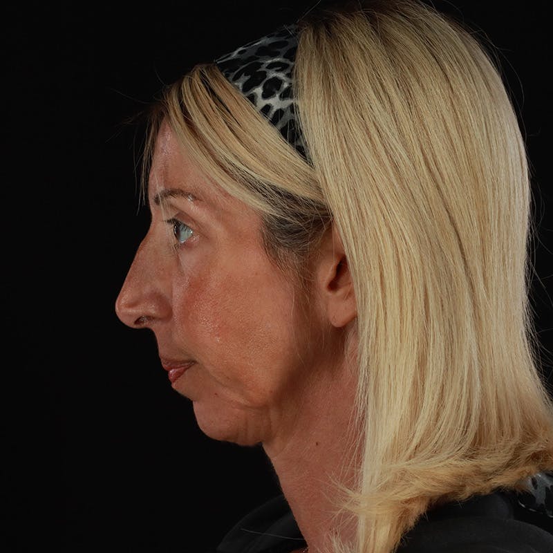 Dermal Fillers Before & After Gallery - Patient 121461 - Image 8