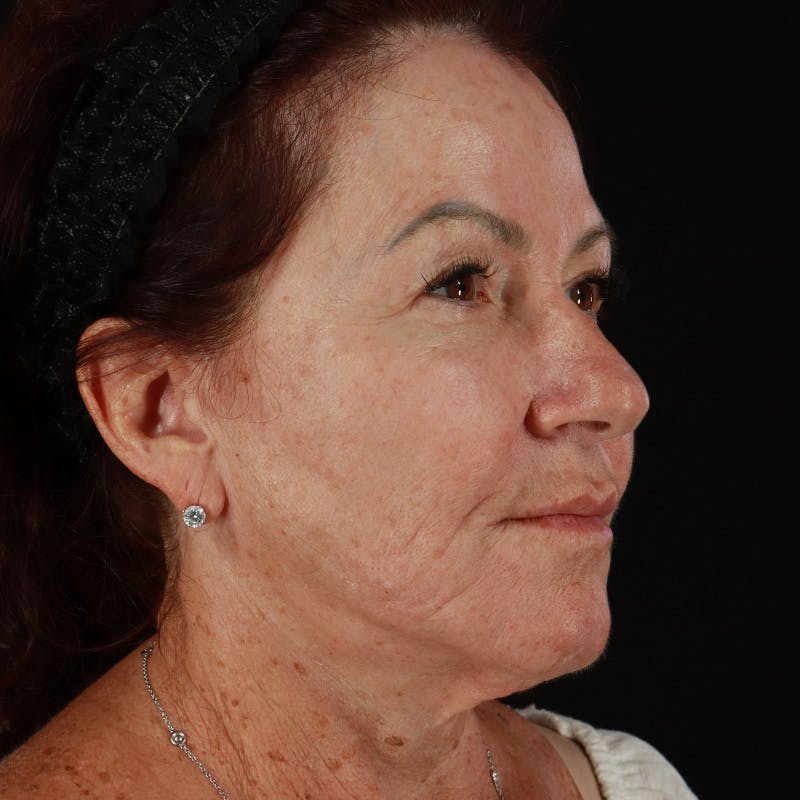Dermal Fillers Before & After Gallery - Patient 115770 - Image 2