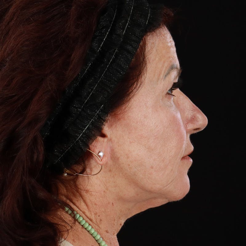 Dermal Fillers Before & After Gallery - Patient 115770 - Image 3