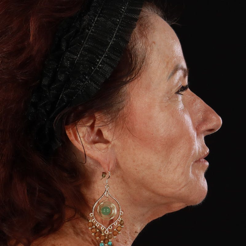 Dermal Fillers Before & After Gallery - Patient 115770 - Image 4
