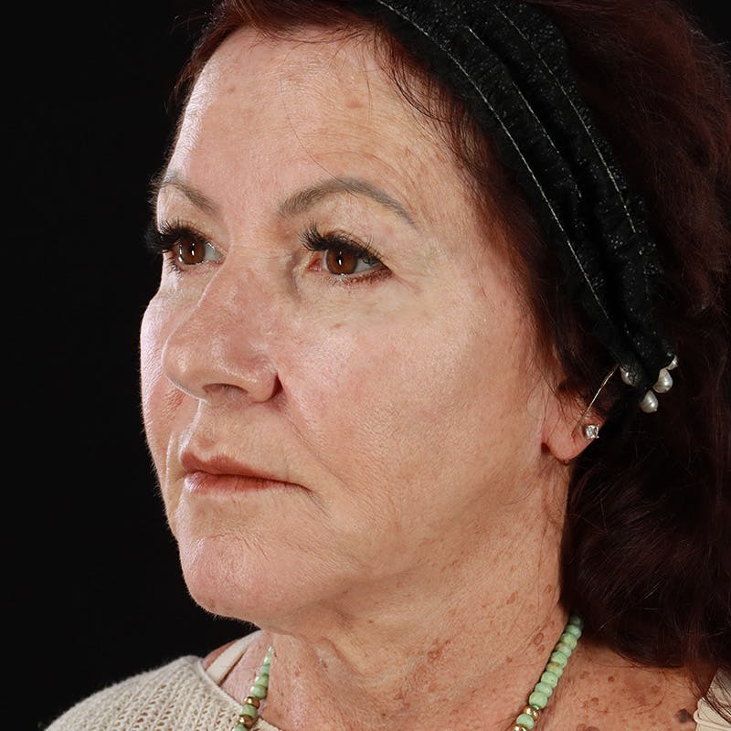 Dermal Fillers Before & After Gallery - Patient 115770 - Image 5