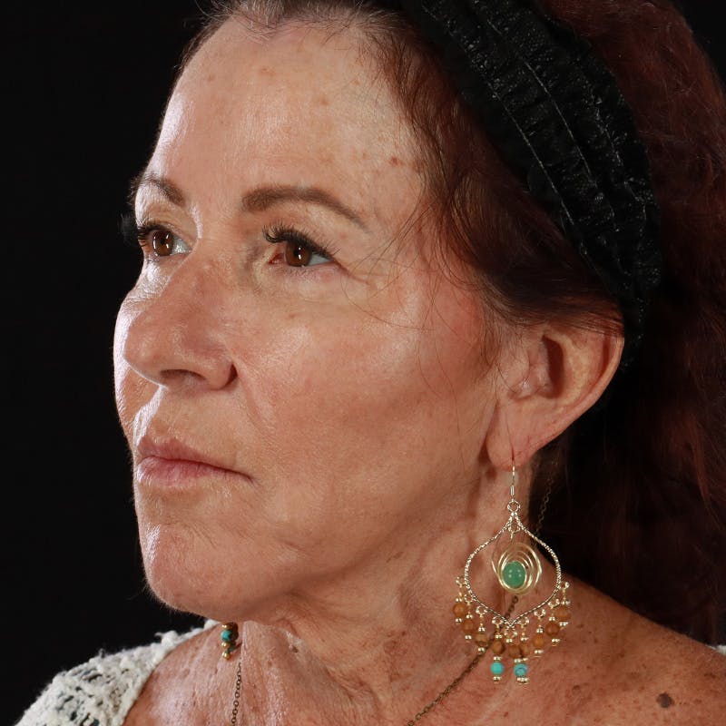 Dermal Fillers Before & After Gallery - Patient 115770 - Image 6