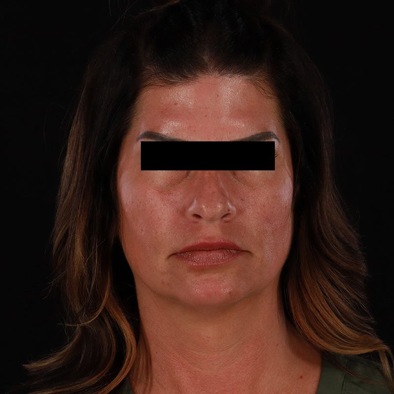 Dermal Fillers Before & After Gallery - Patient 709775 - Image 1
