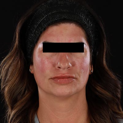 Dermal Fillers Before & After Gallery - Patient 709775 - Image 2