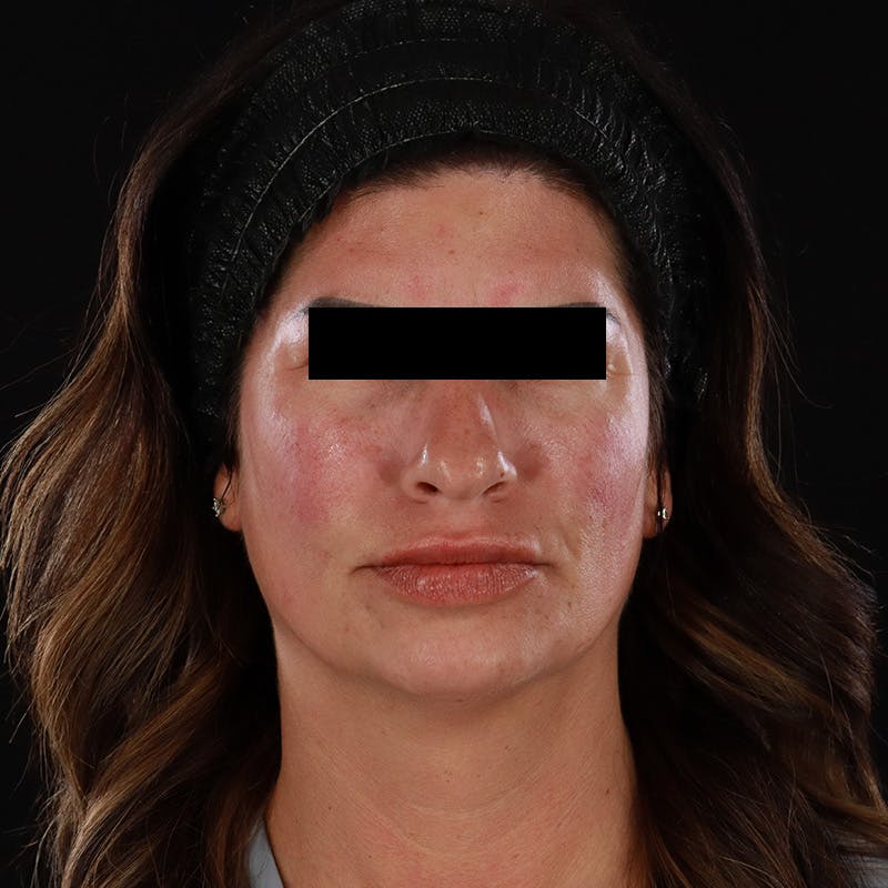 Dermal Fillers Before & After Gallery - Patient 709775 - Image 2