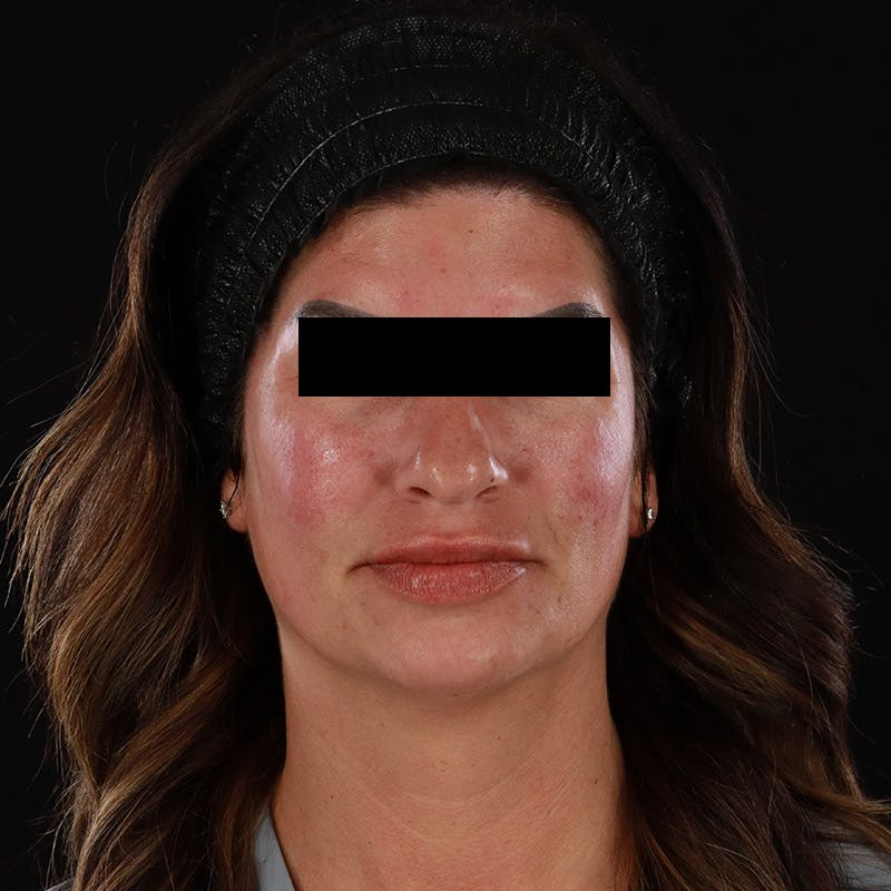 Dermal Fillers Before & After Gallery - Patient 709775 - Image 4