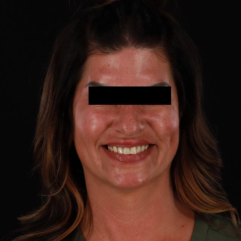 Dermal Fillers Before & After Gallery - Patient 709775 - Image 3
