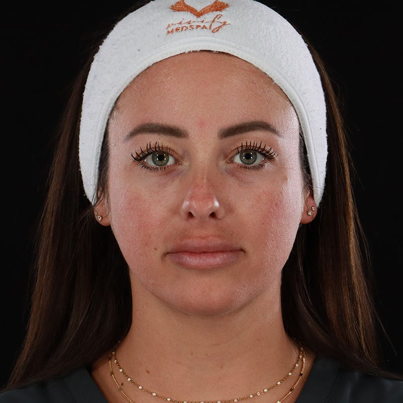 Dermal Fillers Before & After Gallery - Patient 131961 - Image 1
