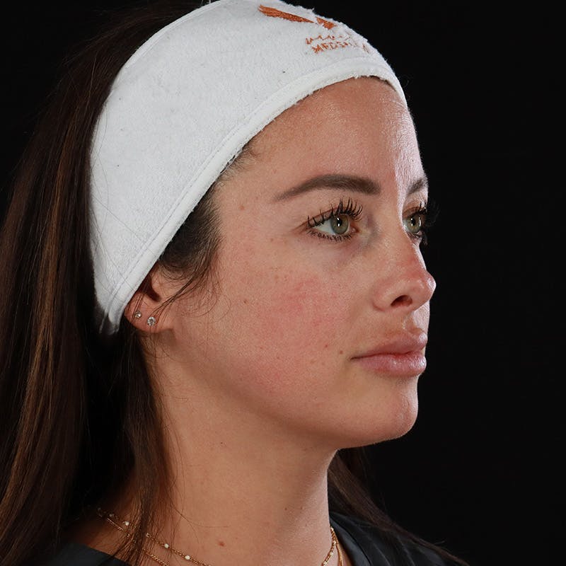 Dermal Fillers Before & After Gallery - Patient 131961 - Image 3
